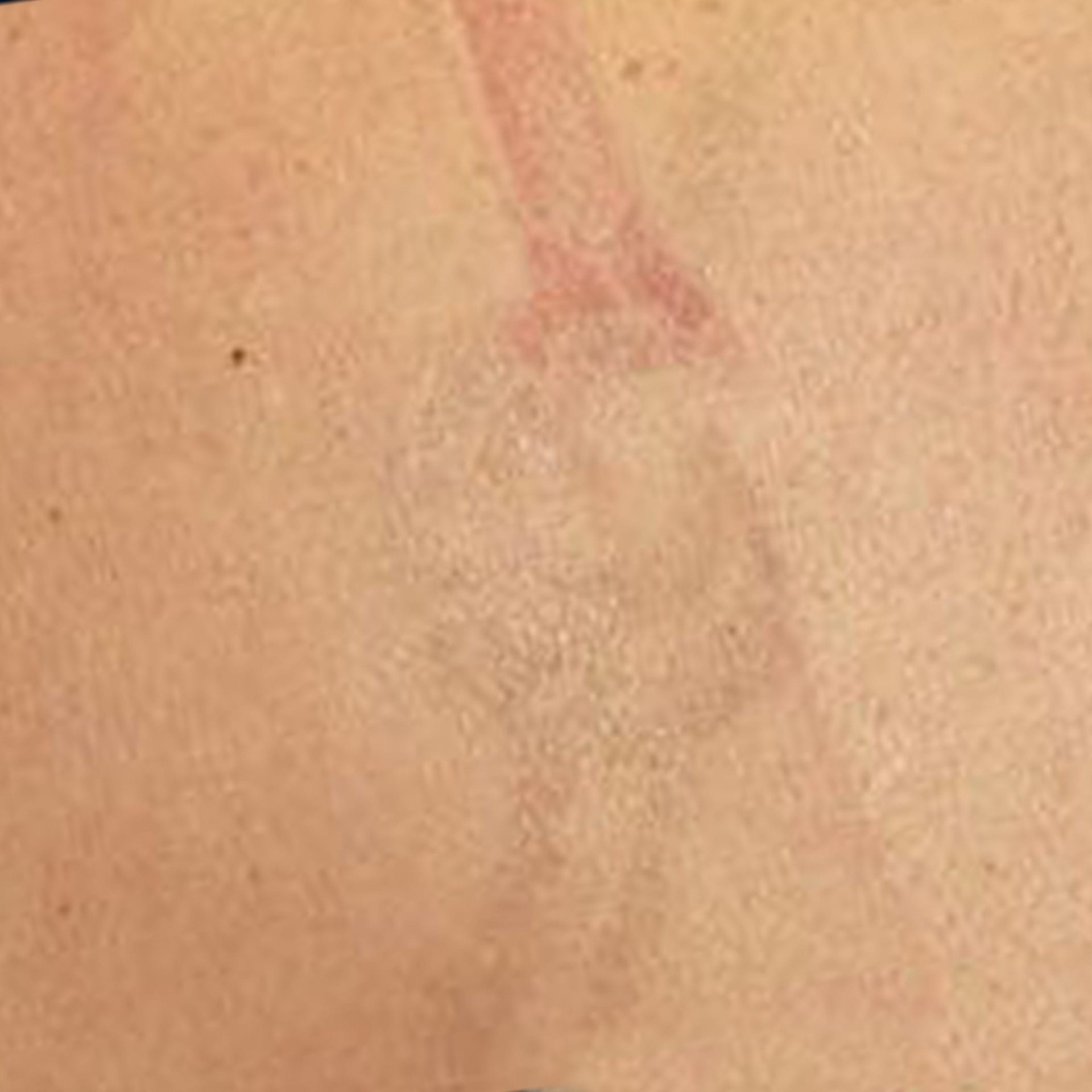 results after first candela laser tattoo