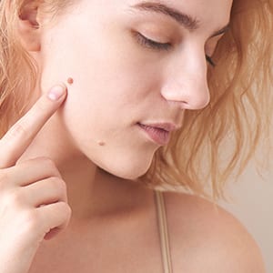 Moles on Face: Condition that Requires Mole Removal Treatment