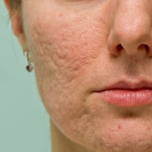 Acne Boxcar scars Cosmetic Medical Clinic - CMC - Sydney