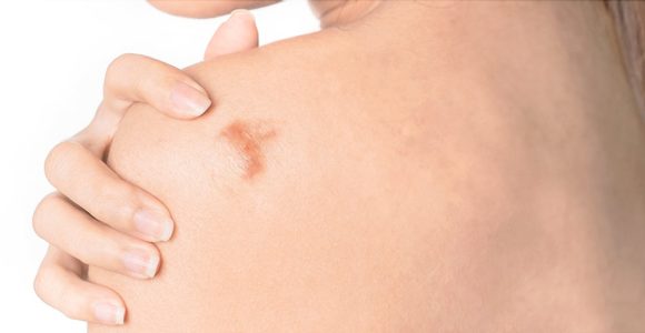 Asian women have keloid scar on shoulder on white background, dermatology and cosmetology concept.