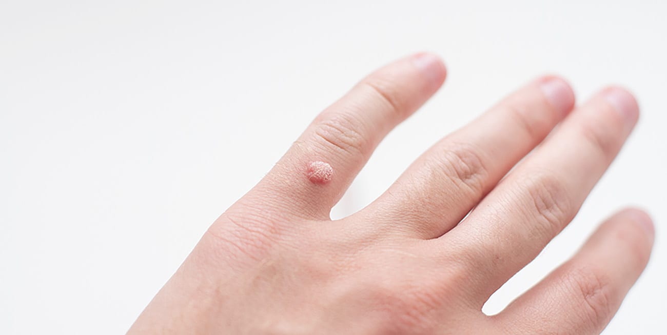 What Causes White Warts On Hands