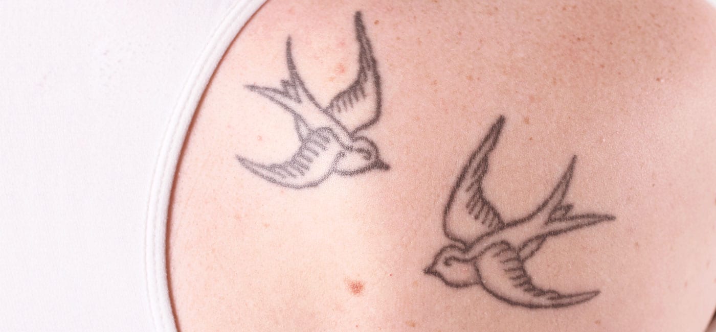 laser tattoo removal - CMC - Cosmetic Medical Clinic Sydney