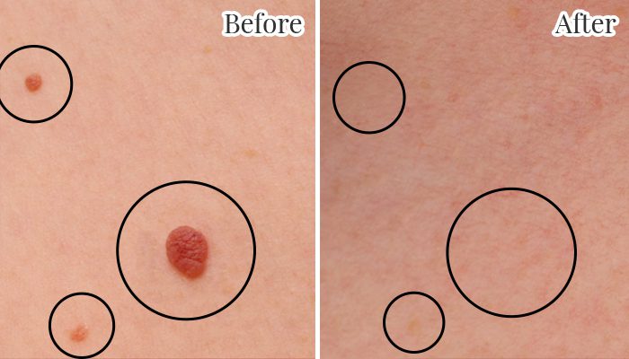 Skin tag removal