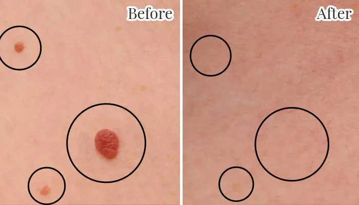 Skin tag removal