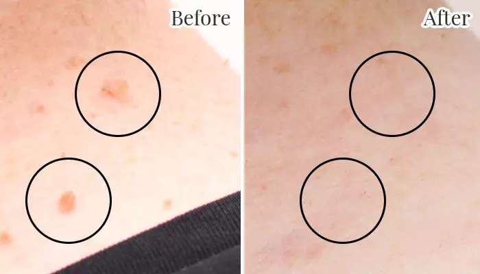 Laser Skin Tag Removal