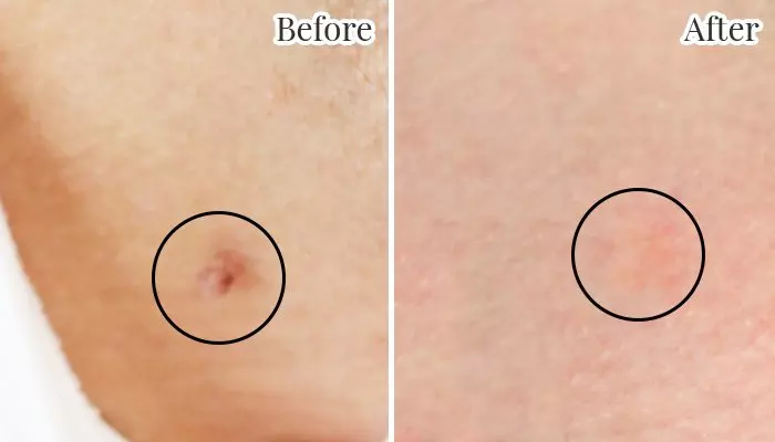 Laser Skin Tag Removal