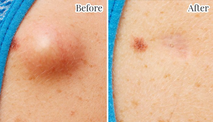 Laser cyst removal sydney