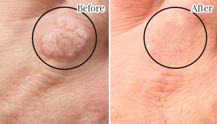 Laser wart removal on hand
