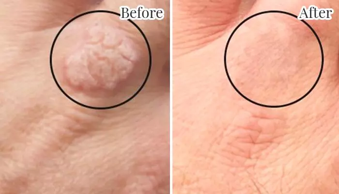 Laser wart removal on hand