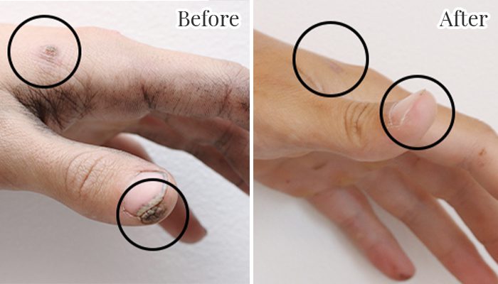 Laser wart removal on hand