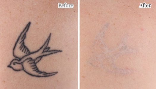 before-and-after-tattoo1 before-and-after-tattoo1