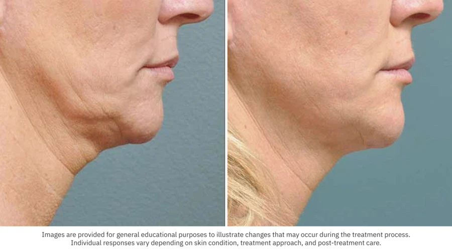 Before After Skin Tightening 01