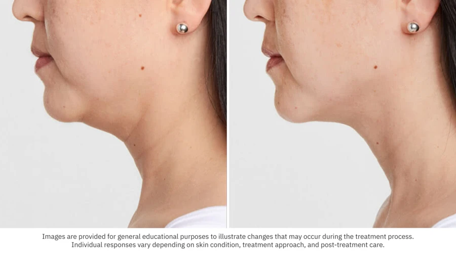 Before After Skin Tightening 03