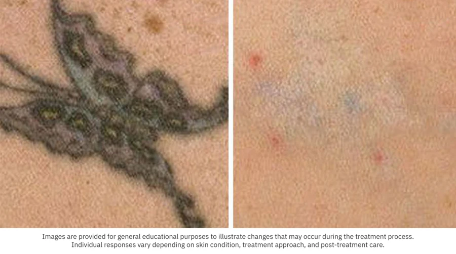 Before After Tattoo 02